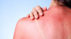 sunburn skin damage